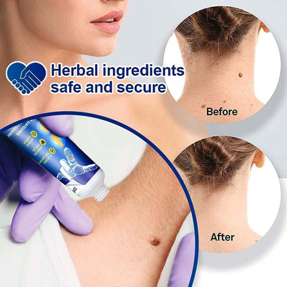 Warts Remover Cream (Pack Of 2)(PL)